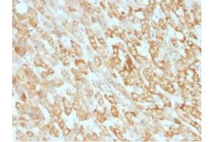 Formalin-fixed, paraffin-embedded human Hepatic Carcinoma stained with Prohibitin Mouse Monoclonal Antibody (SPM311). (Prohibitin 抗体  (AA 167-261))