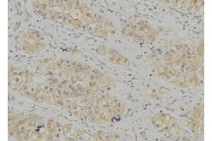 ABIN6272936 at 1/100 staining Human breast cancer tissue by IHC-P. (AP3B1 抗体  (C-Term))