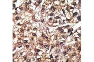 IHC analysis of FFPE human hepatocarcinoma tissue stained with the PINK1 antibody (PINK1 抗体  (AA 118-147))
