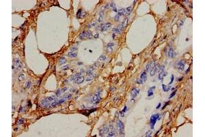 Immunohistochemistry analysis of human pancreatic cancer using ABIN7169051 at dilution of 1:100 (ICK 抗体  (AA 150-275))