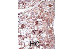 Formalin-fixed and paraffin-embedded human hepatocellular carcinoma tissue reacted with PCK1 polyclonal antibody  , which was peroxidase-conjugated to the secondary antibody, followed by DAB staining. (PCK1 抗体  (N-Term))