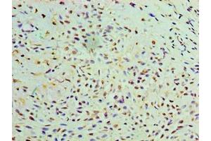 Immunohistochemistry of paraffin-embedded human breast cancer using ABIN7174611 at dilution of 1:100 (GALE 抗体  (AA 1-348))