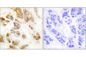 Immunohistochemistry analysis of paraffin-embedded human breast carcinoma, using CaMK1-alpha (Phospho-Thr177) Antibody. (CAMK1 抗体  (pThr177))