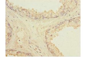 Immunohistochemistry of paraffin-embedded human prostate cancer using ABIN7158367 at dilution of 1:100 (LMO4 抗体  (AA 1-165))