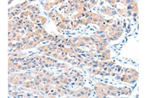 The image on the left is immunohistochemistry of paraffin-embedded Human lung cancer tissue using ABIN7128234(ADAM32 Antibody) at dilution 1/15, on the right is treated with fusion protein. (ADAM32 抗体)