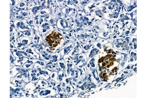 ABIN6265446 and ABIN6278639 at 1/100 staining human gastric cancer by IHC-P. (TAL1 抗体  (C-Term))