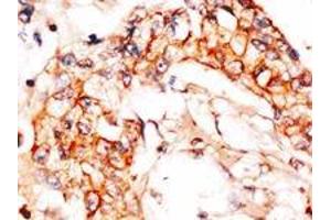 Formalin-fixed and paraffin-embedded human breast carcinoma reacted with anti-APPBP1 (C-term), which was peroxidase-conjugated to the secondary antibody, followed by DAB staining. (NAE1 抗体  (C-Term))