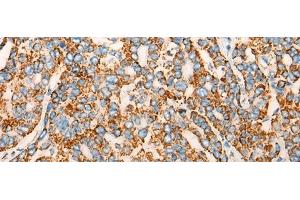 Immunohistochemistry of paraffin-embedded Human liver cancer tissue using CHCHD3 Polyclonal Antibody at dilution of 1:45(x200) (CHCHD3 抗体)