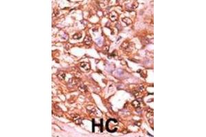 Immunohistochemistry (IHC) image for anti-Signal Transducer and Activator of Transcription 5A (STAT5A) (pSer726) antibody (ABIN5021402) (STAT5A 抗体  (pSer726))