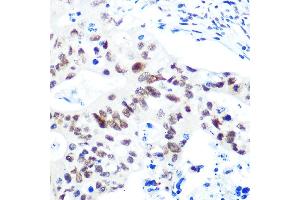 Immunohistochemistry of paraffin-embedded human colon carcinoma using HD Rabbit mAb (ABIN1680476, ABIN3015870, ABIN3015871 and ABIN7101453) at dilution of 1:100 (40x lens). (HDAC9 抗体)