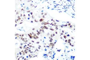 Immunohistochemistry of paraffin-embedded human colon carcinoma using HD Rabbit mAb (ABIN1680476, ABIN3015870, ABIN3015871 and ABIN7101453) at dilution of 1:100 (40x lens).