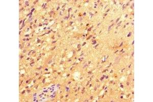 Immunohistochemistry of paraffin-embedded human glioma using ABIN7147801 at dilution of 1:100 (IRG1 抗体  (AA 57-257))