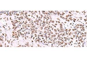 Immunohistochemistry of paraffin-embedded Human ovarian cancer tissue using NASP Polyclonal Antibody at dilution of 1:55(x200) (NASP 抗体)