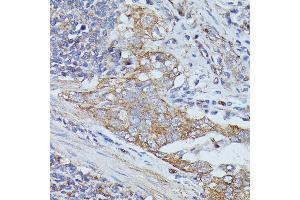 Immunohistochemistry of paraffin-embedded human lung cancer using Cortactin antibody  at dilution of 1:100 (40x lens). (Cortactin 抗体  (AA 1-200))