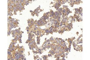 Immunohistochemistry analysis of paraffin-embedded human stomach cancer using TEK Polyclonal Antibody at dilution of 1:200.