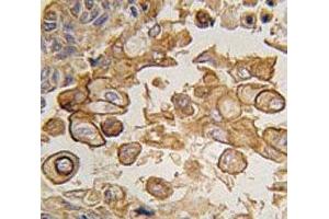 IHC analysis of FFPE human lung carcinoma tissue stained with TLR6 antibody (TLR6 抗体  (AA 722-753))