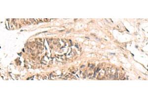 Immunohistochemistry of paraffin-embedded Human colorectal cancer tissue using ABCB4 Polyclonal Antibody at dilution of 1:70(x200) (ABCB4 抗体)