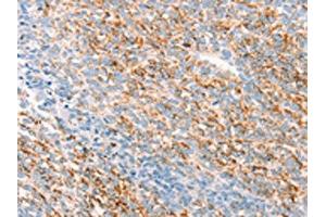 The image on the left is immunohistochemistry of paraffin-embedded Human ovarian cancer tissue using ABIN7192795(THY1 Antibody) at dilution 1/25, on the right is treated with synthetic peptide. (CD90 抗体)