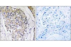 Immunohistochemistry analysis of paraffin-embedded human breast carcinoma tissue, using NDUFS6 Antibody. (NDUFS6 抗体  (AA 75-124))
