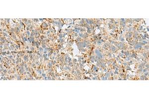 Immunohistochemistry of paraffin-embedded Human cervical cancer tissue using VDAC3 Polyclonal Antibody at dilution of 1:30(x200) (VDAC3 抗体)