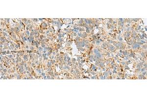 Immunohistochemistry of paraffin-embedded Human cervical cancer tissue using VDAC3 Polyclonal Antibody at dilution of 1:30(x200) (VDAC3 抗体)