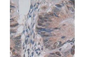 IHC-P analysis of Human Tissue, with DAB staining. (PKN2 抗体  (AA 67-312))