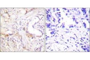 Immunohistochemistry analysis of paraffin-embedded human lung carcinoma tissue, using PIAS3 Antibody. (PIAS3 抗体  (AA 10-59))
