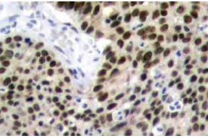 Immunohistochemistry (IHC) analyzes of HSF1 antibody in paraffin-embedded human breast carcinoma tissue. (HSF1 抗体)