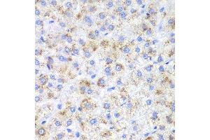 Immunohistochemistry of paraffin-embedded human liver cancer using HAO1 antibody. (HAO1 抗体  (AA 1-370))
