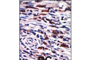 Formalin-fixed and paraffin-embedded human cancer tissue reacted with the primary antibody, which was peroxidase-conjugated to the secondary antibody, followed by AEC staining. (PKC eta 抗体  (N-Term))