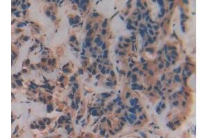 Detection of VAV3 in Human Breast cancer Tissue using Polyclonal Antibody to Vav 3 Oncogene (VAV3) (VAV3 抗体  (AA 183-380))