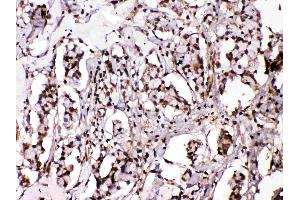 Islet 1 was detected in paraffin-embedded sections of human mammary cancer tissues using rabbit anti- Islet 1 Antigen Affinity purified polyclonal antibody (Catalog # ) at 1 µg/mL. (ISL1 抗体  (Middle Region))