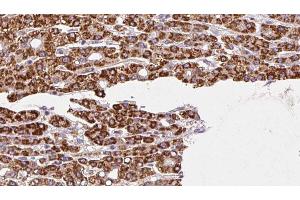 ABIN6272458 at 1/100 staining Human liver cancer tissue by IHC-P. (Vomeronasal 1 Receptor 3 (VMN1R3) 抗体)