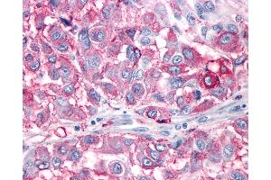 Anti-NPY1R antibody IHC of human Skin, Melanoma. (NPY1R 抗体  (Cytoplasmic Domain))