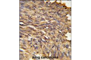 Formalin-fixed and paraffin-embedded human lung carcinoma reacted with HDLBP Antibody , which was peroxidase-conjugated to the secondary antibody, followed by DAB staining.