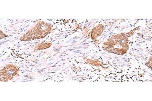 Immunohistochemistry of paraffin-embedded Human esophagus cancer tissue using SASH1 Polyclonal Antibody at dilution of 1:30(x200) (SASH1 抗体)