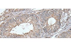 Immunohistochemistry of paraffin-embedded Human colorectal cancer tissue using UNC13B Polyclonal Antibody at dilution of 1:40(x200) (UNC13B 抗体)