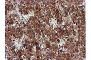 Immunohistochemical staining of paraffin-embedded Carcinoma of Human liver tissue using anti-EPM2AIP1 mouse monoclonal antibody. (EPM2AIP1 抗体)