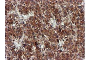 Immunohistochemical staining of paraffin-embedded Carcinoma of Human liver tissue using anti-EPM2AIP1 mouse monoclonal antibody.