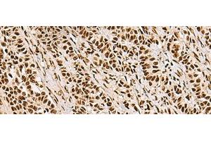 Immunohistochemistry of paraffin-embedded Human ovarian cancer tissue using FOXI1 Polyclonal Antibody at dilution of 1:55(x200)