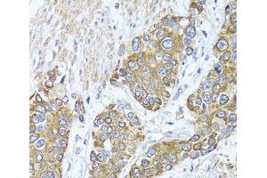 Immunohistochemistry of paraffin-embedded Human prostate cancer using PEX14 Polyclonal Antibody at dilution of 1:100 (40x lens). (PEX14 抗体)