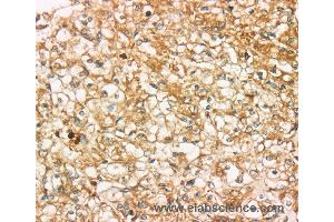 Immunohistochemistry of Human prostate cancer using SIGLEC15 Polyclonal Antibody at dilution of 1:35