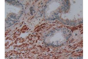 Detection of PLAP in Human Prostate Gland Tissue using Polyclonal Antibody to Phospholipase A2 Activating Protein (PLAP) (PLAA 抗体  (AA 162-312))
