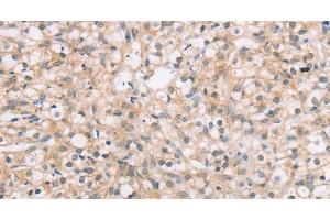 Immunohistochemistry of paraffin-embedded Human prostate cancer tissue using ROR1 Polyclonal Antibody at dilution 1:45 (ROR1 抗体)