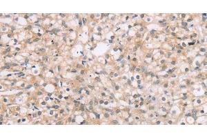 Immunohistochemistry of paraffin-embedded Human prostate cancer tissue using ROR1 Polyclonal Antibody at dilution 1:45 (ROR1 抗体)