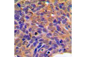 Immunohistochemical analysis of Beta-catenin staining in human breast cancer formalin fixed paraffin embedded tissue section. (beta Catenin 抗体  (C-Term))