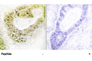 Immunohistochemistry analysis of paraffin-embedded human colon carcinoma tissue using ZNF638 polyclonal antibody . (ZNF638 抗体)