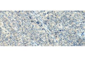 Immunohistochemistry of paraffin-embedded Human ovarian cancer tissue using NPVF Polyclonal Antibody at dilution of 1:80(x200) (NPVF 抗体)