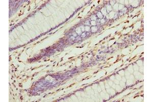 Immunohistochemistry of paraffin-embedded human colon cancer using ABIN7142940 at dilution of 1:100 (ILVBL 抗体  (AA 45-344))
