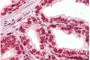 Human Prostate (formalin-fixed, paraffin-embedded) stained with APEX1 antibody ABIN396973 at 1:250 followed by biotinylated goat anti-rabbit IgG secondary antibody ABIN481713, alkaline phosphatase-streptavidin and chromogen. (APEX1 抗体)